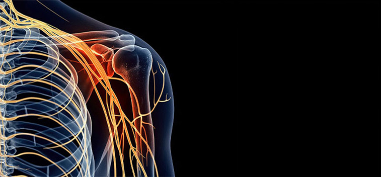 patient experiencing Brachial Plexus Neuropathy and in need of the neuropathy treatment protocol at Monumental Health and Wellness in Colville
