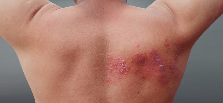 patient experiencing Post-Herpetic Neuralgia and in need of the neuropathy treatment protocol at Monumental Health and Wellness in Colville